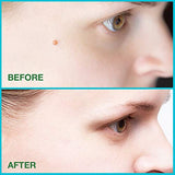 Elvanya Skin Tag Remover - Mole Remover- Mushroom Cookies Skin Tag Removal 2PC