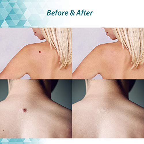 Skin Tag Remover Cream - Fast & Effective, Get Rid of Unwanted Skin Tags