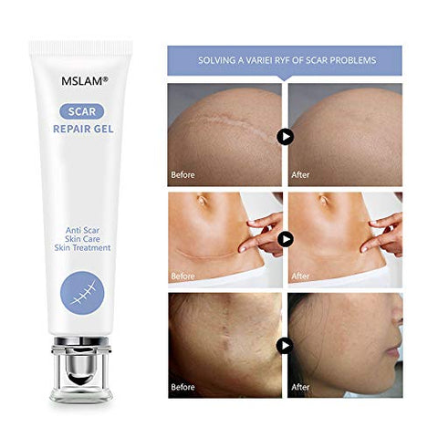 Scar Removal Gel - Effectively Fades Scars Keloids Acne & Surgical Marks