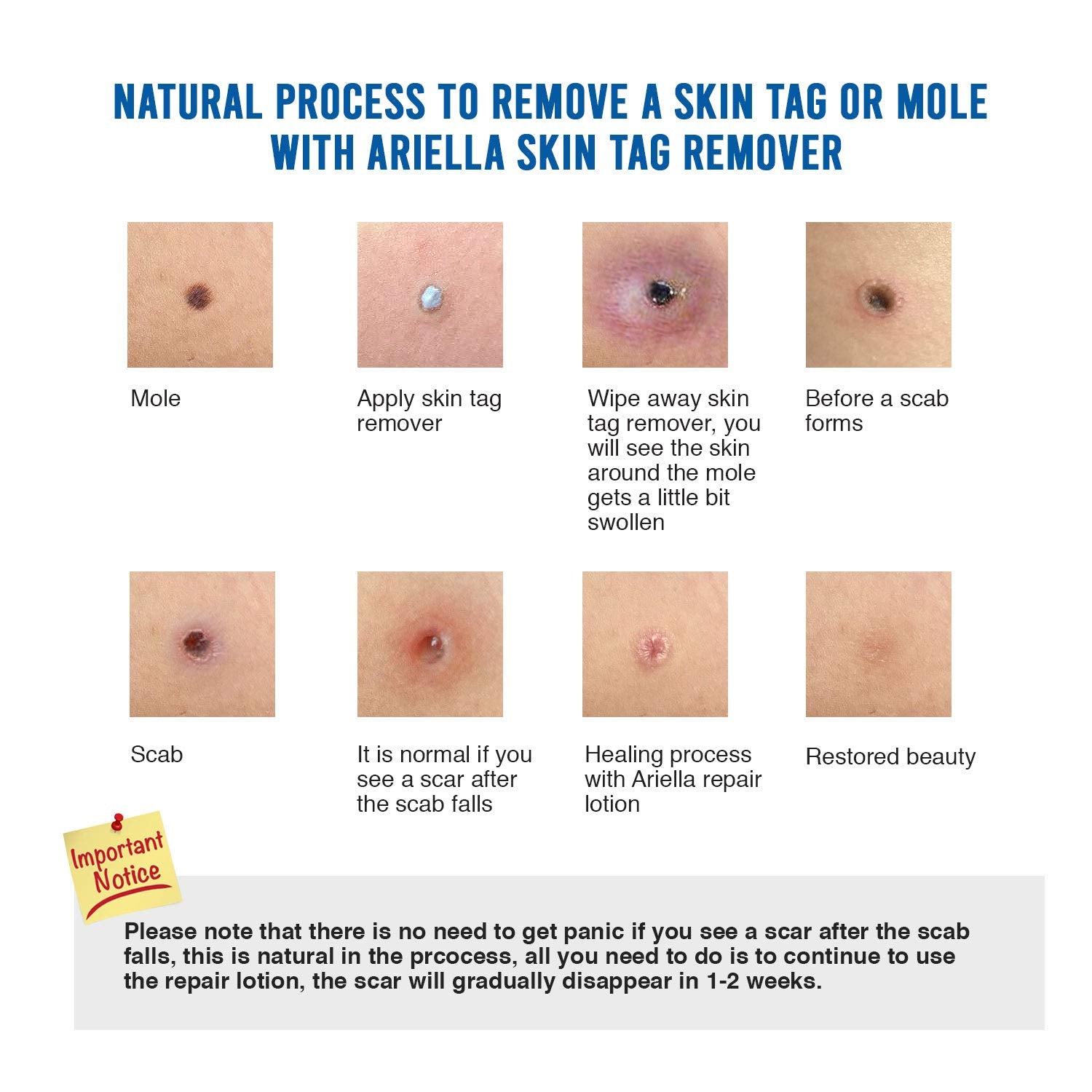 Ariella Removal Treatment-Made of Natural Plant Extracts-Simple and Easy to Apply Skin Tag Remover & Mole Corrector and Repair Lotion Set,