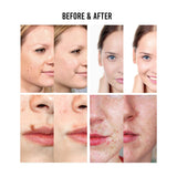 Ariella Removal Treatment-Made of Natural Plant Extracts-Simple and Easy to Apply Skin Tag Remover & Mole Corrector and Repair Lotion Set,