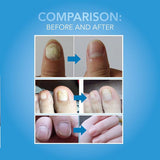 Arishine Fungus Treatment,  Anti Fungus Nail Treatment, Effective Against Nail Fungus, Anti Fungal Nail Solution
