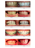 AuraGlow Teeth Whitening Kit, LED Light, 35% Carbamide Peroxide, (2) 5ml Gel Syringes