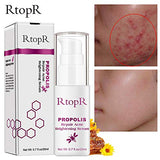 RtopR Propolis Repair Acne Serum, Acne Treatment Serum, Moisturizing Control Oil Anti-Acne Serum - Shrink Pores, Remove Scar Spot Cleaning Essence - Repair Skin