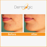 Dermlogic Acne Treatment Pads-Contains Glycolic, Lactic, Salicylic Acid. Eliminates Oily Skin, Clogged Pores & Cystic Breakouts. Removes Dark Spots, Whitehead & Blackhead Pimples for Face & Body.