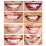 iSmile Teeth Whitening Kit with LED Light, No Sensitivity, Professional RED & Blue Technology, 35% Carbamide Peroxide Pens & Desensitizing Gel Pen, Sensitive Direct Tooth Whitener at Home