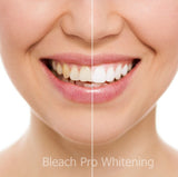 Teeth Whitening Kit 44% Carbamide Peroxide Tooth Bleaching Gel 6 Syringe Dispensers, 2 Thermo Forming Dental Tray with Storage Case.