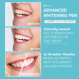 Pur White Teeth Whitening System Teeth Whitener Brilliant Complete Teeth Whitening Kit With LED Light, Smartphone Hook Up, Long Lasting White Teeth Results (36% Carbamide Peroxide)
