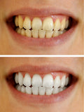 Teeth Whitening Kit 35% Carbamide Peroxide, 10 Tooth Bleaching Gel Syringe Dispensers, 2 Thermo Forming Dental Trays with Storage Case