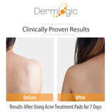 Dermlogic Acne Treatment Pads-Contains Glycolic, Lactic, Salicylic Acid. Eliminates Oily Skin, Clogged Pores & Cystic Breakouts. Removes Dark Spots, Whitehead & Blackhead Pimples for Face & Body.