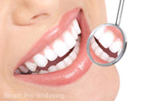 Teeth Whitening Kit 35% Carbamide Peroxide, 10 Tooth Bleaching Gel Syringe Dispensers, 2 Thermo Forming Dental Trays with Storage Case