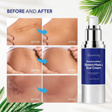 Scar Remover Cream, Premium Edition Scar Removal Cream for Scars from C-Section, Stretch Marks, Acne, Surgery, Injury, Burns, Effective for both Old and New Scars, Made in Canada