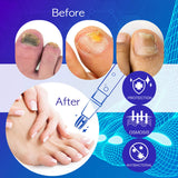Fungus Stop, Biological Repair Pencil, Anti Fungus Nail Treatment, Toe Nails and Finger Nails Repair Pen, Fragile Nails Care Solution, Foot Therapy Antifungal Treatment
